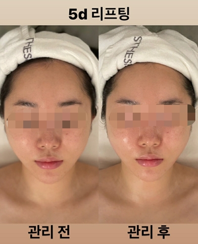 울트라5D리프팅