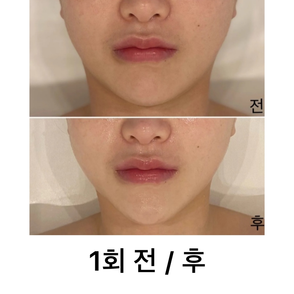 작은얼굴관리