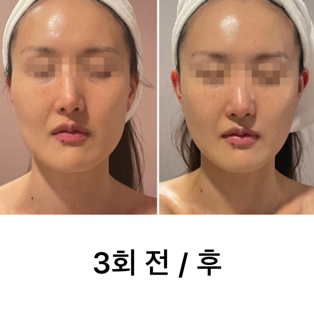 작은얼굴관리
