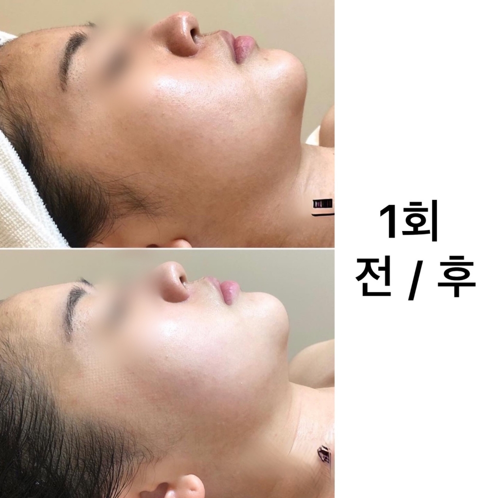 작은얼굴관리