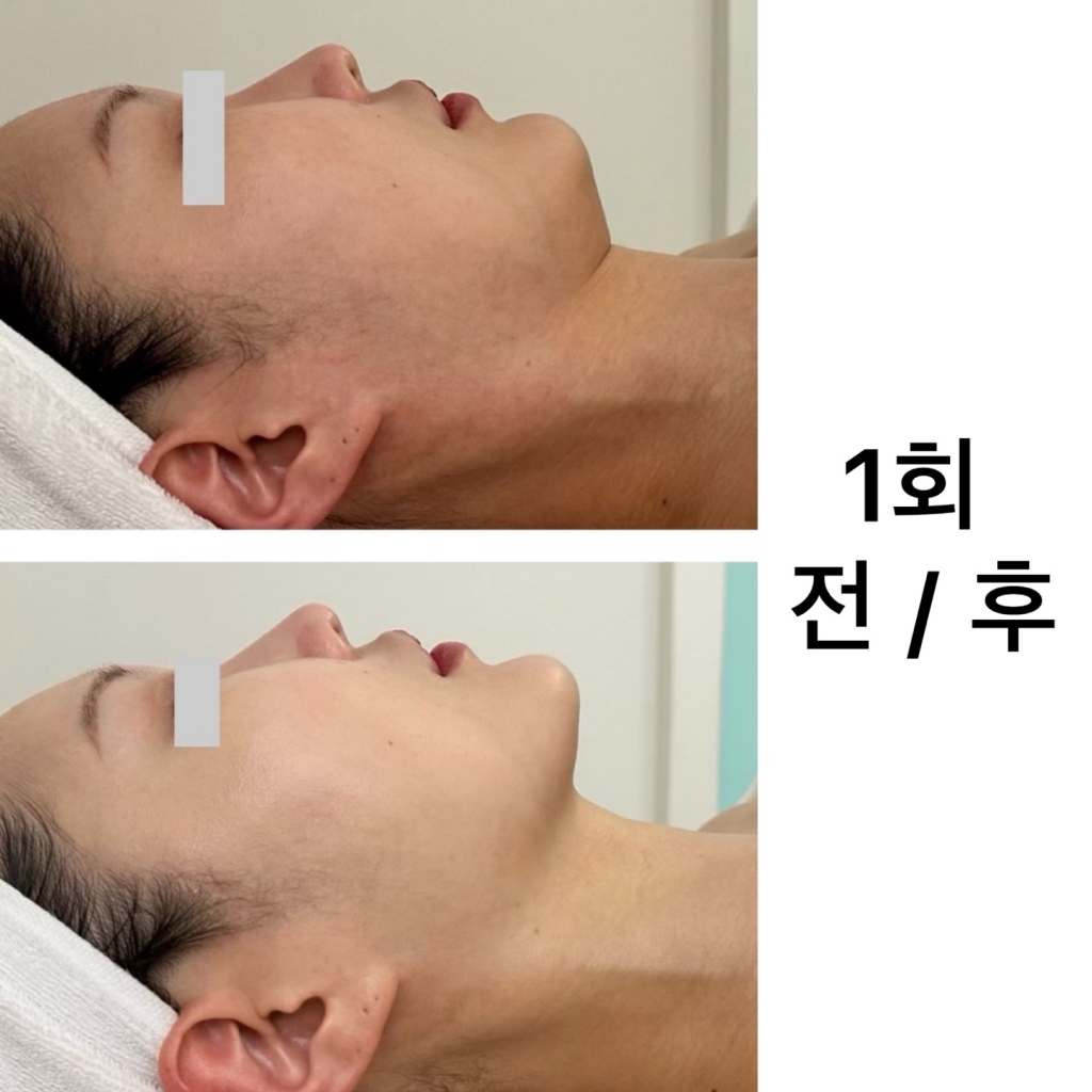 작은얼굴관리