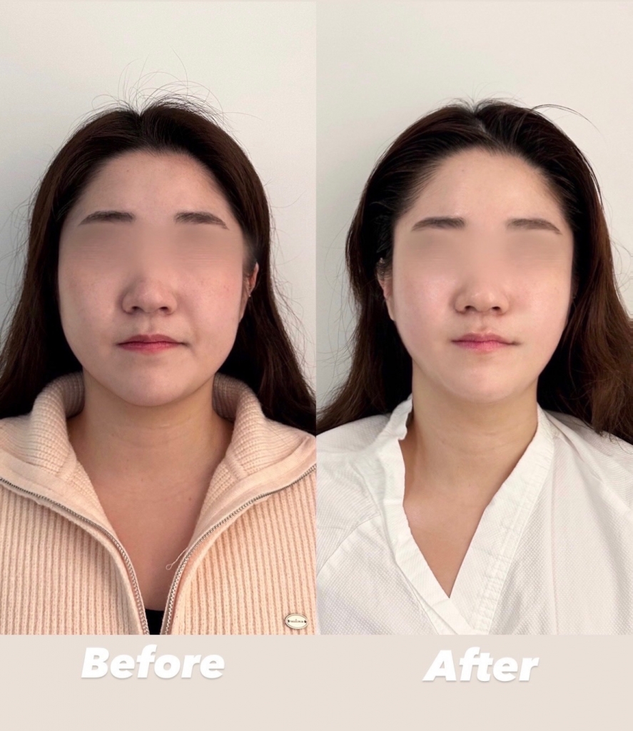 작은얼굴관리